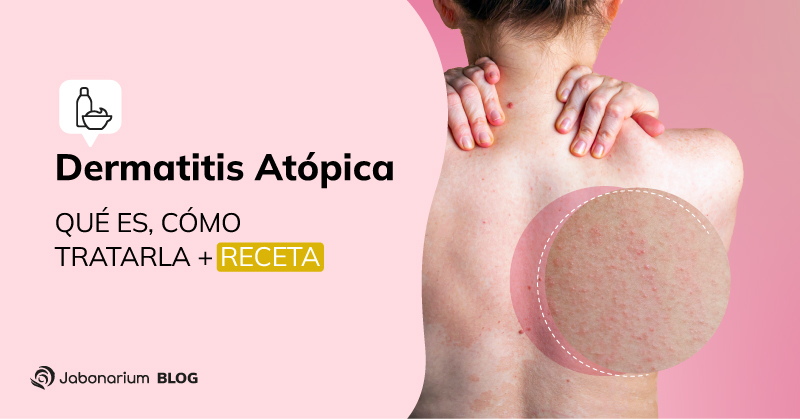 Dermatitis Atópica: Tratamientos Naturales para su alivio